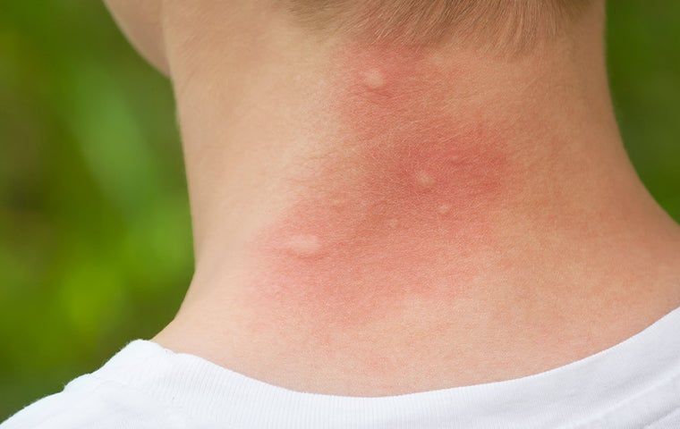 How to Avoid Heat Rash - Buckhead Dermatology